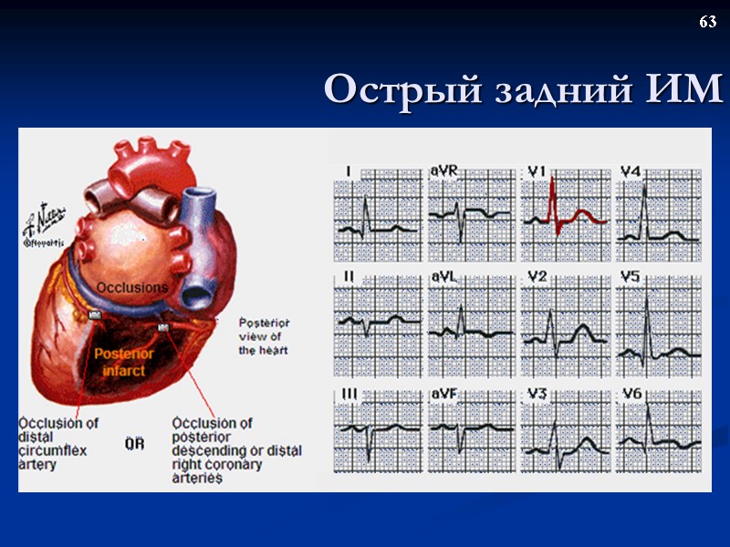 63 Острый задний ИМ